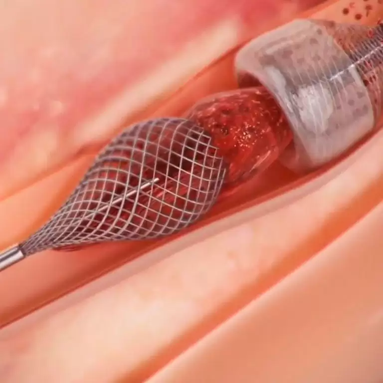 Megavasc Capture Vascular: remoção de coágulos em doenças vasculares